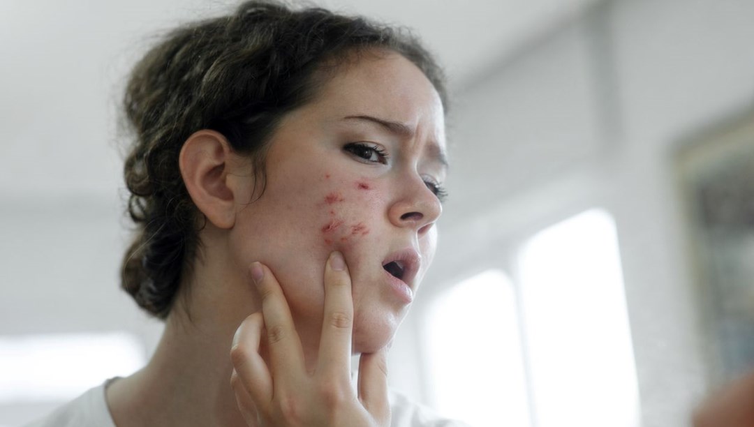 Dermatolog açıkladı: Basit bir sivilce kanserin işareti olabilir