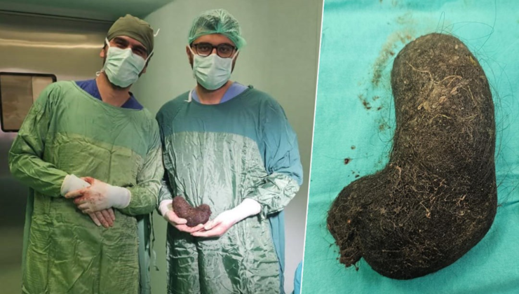 “Midem bulanıyor” dedi, midesinden çıkanlar doktorları şaşırttı