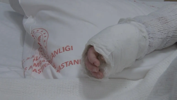 Üzerine kaynar su dökülen 20 aylık bebek taburcu edildi